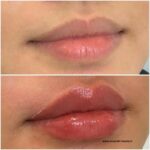 حجم دهنده لب گابرینی